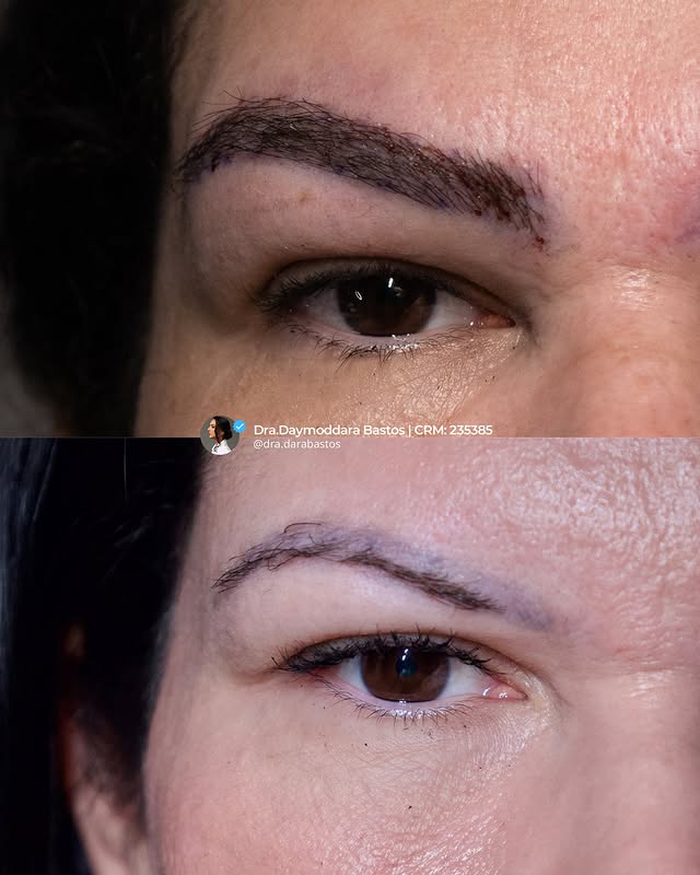 Resultado real - Transplante de Sobrancelhas FUE
